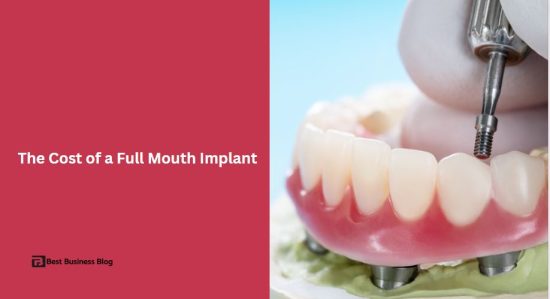 The Cost of a Full Mouth Implant